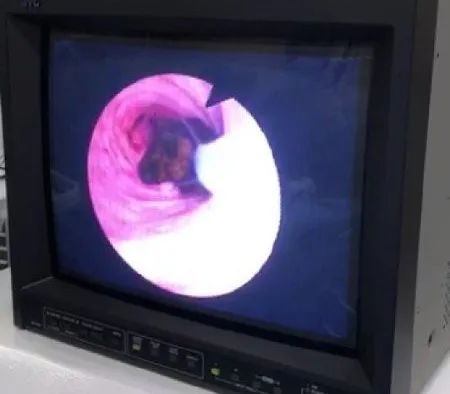 更小伤口 更好人生——普外二病区LTCBDE手术2